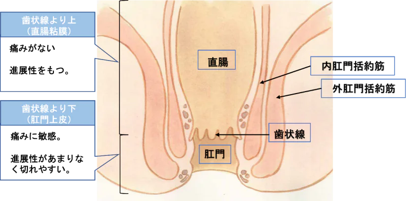 『いぼ痔（痔核）』とは？