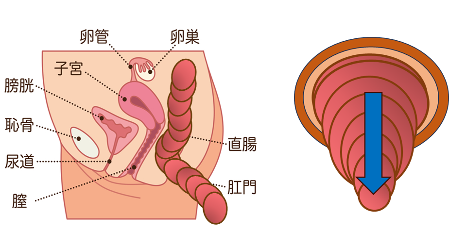 完全直腸脱