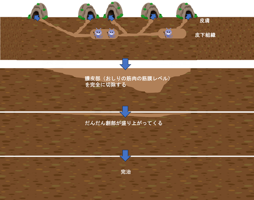 膿皮症（化膿性汗腺炎）の治療