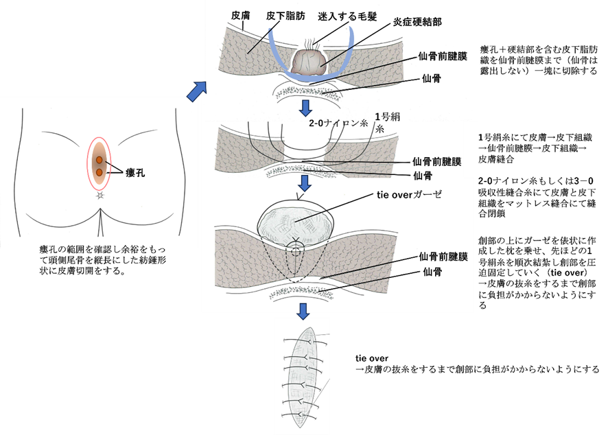 仙骨部毛巣洞の治療