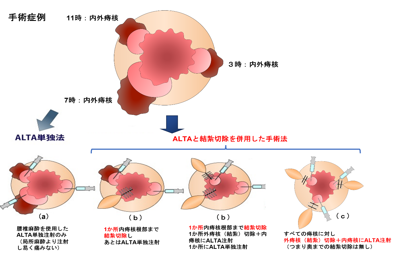 内痔核まで切り込まない外痔核切除＋ALTA（ジオン®）注射併用の複数箇所手術