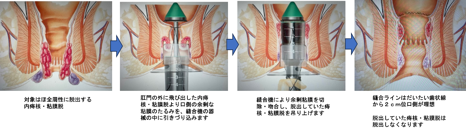 ＰＰＨ（器械縫合機）による全周性痔核・粘膜脱手術