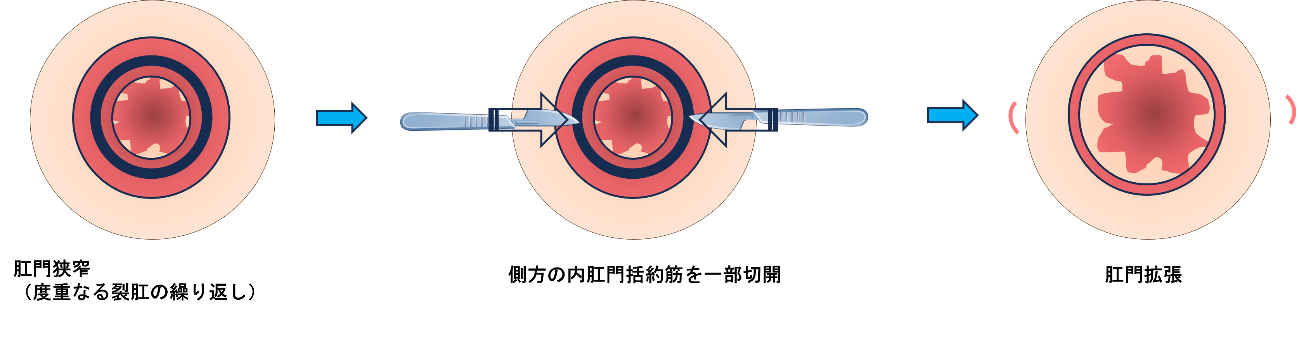 肛門狭窄拡張手術（側方内肛門括約筋切開（LSIS）で済むもの）