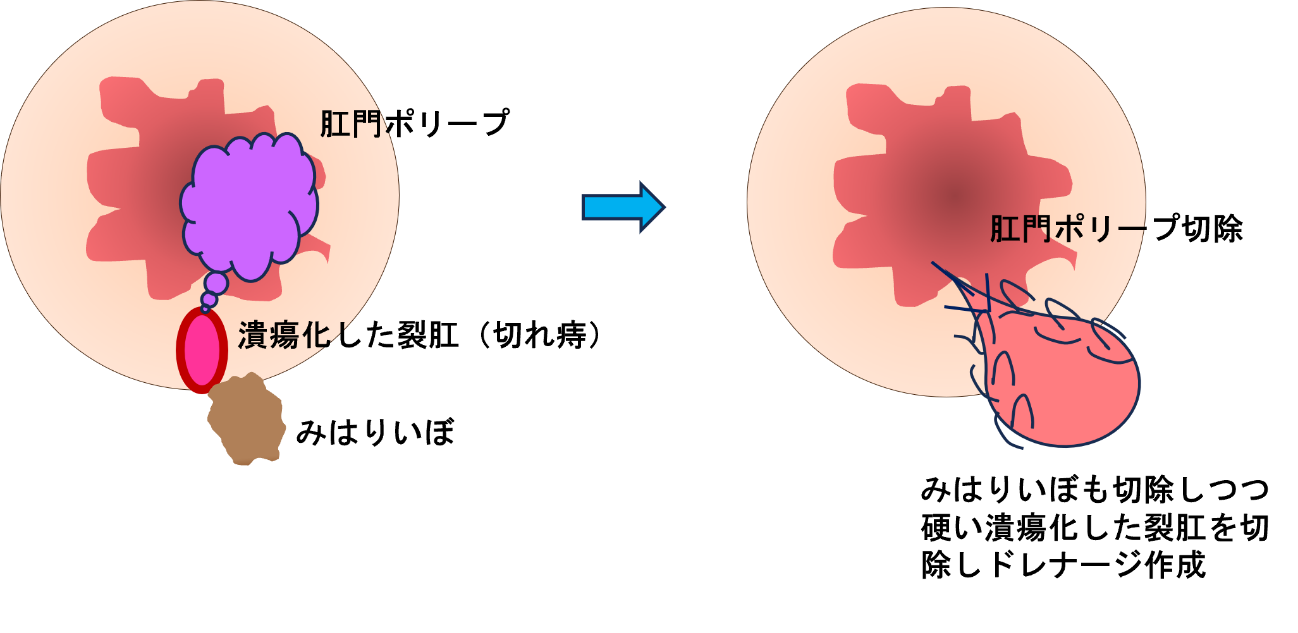 1か所の肛門狭窄を伴わない裂肛（肛門潰瘍）＋肛門ポリープ（みはりいぼ）切除手術