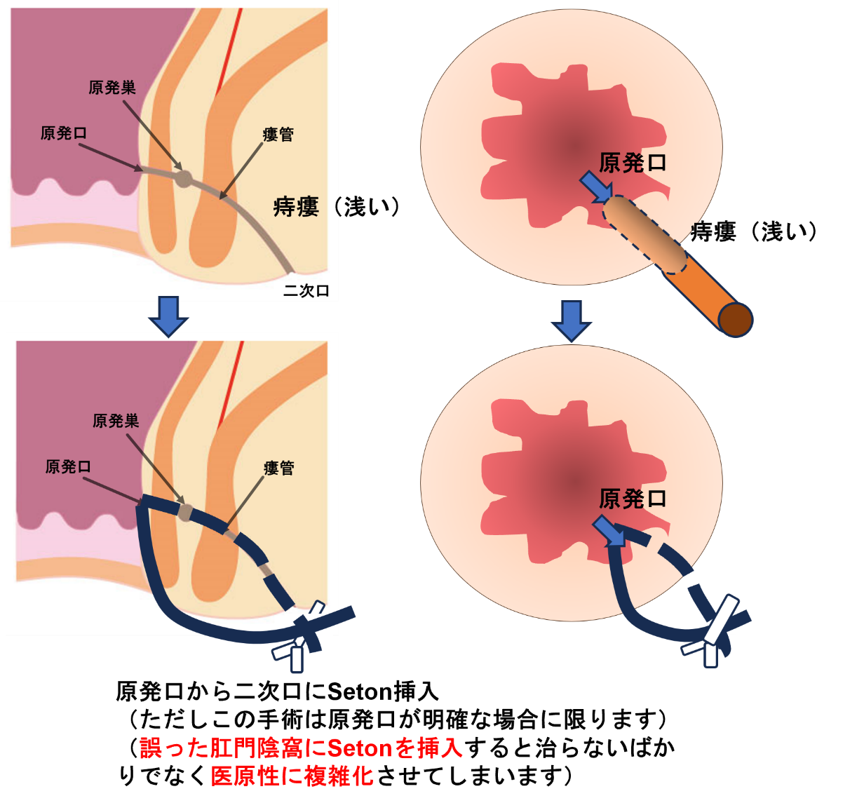 浅い痔瘻根治手術（Seton　シートン法、LayOpen法）