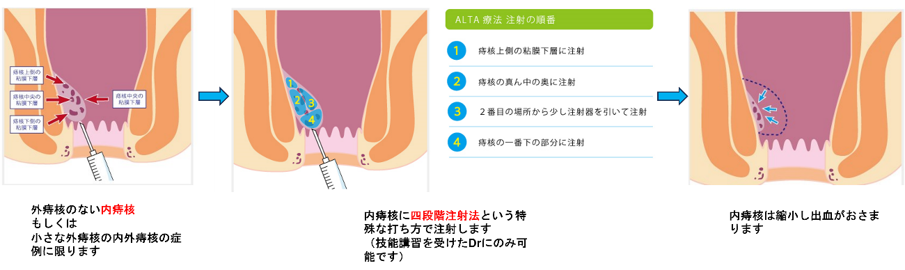 硬化療法　（パオスクレー、ALTA（ジオン®）注射）のみの手術