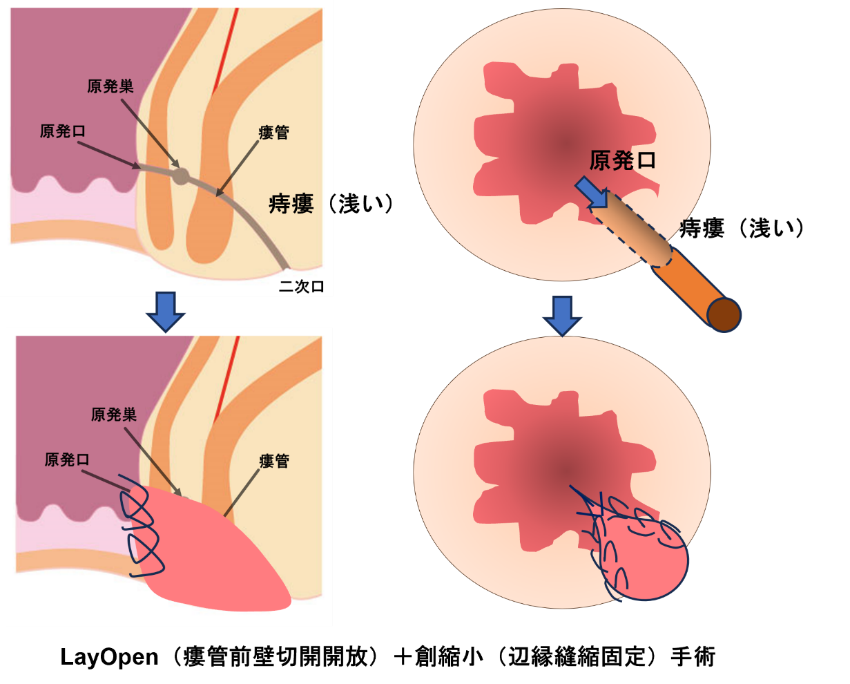 LayOpen（切開開放）手術