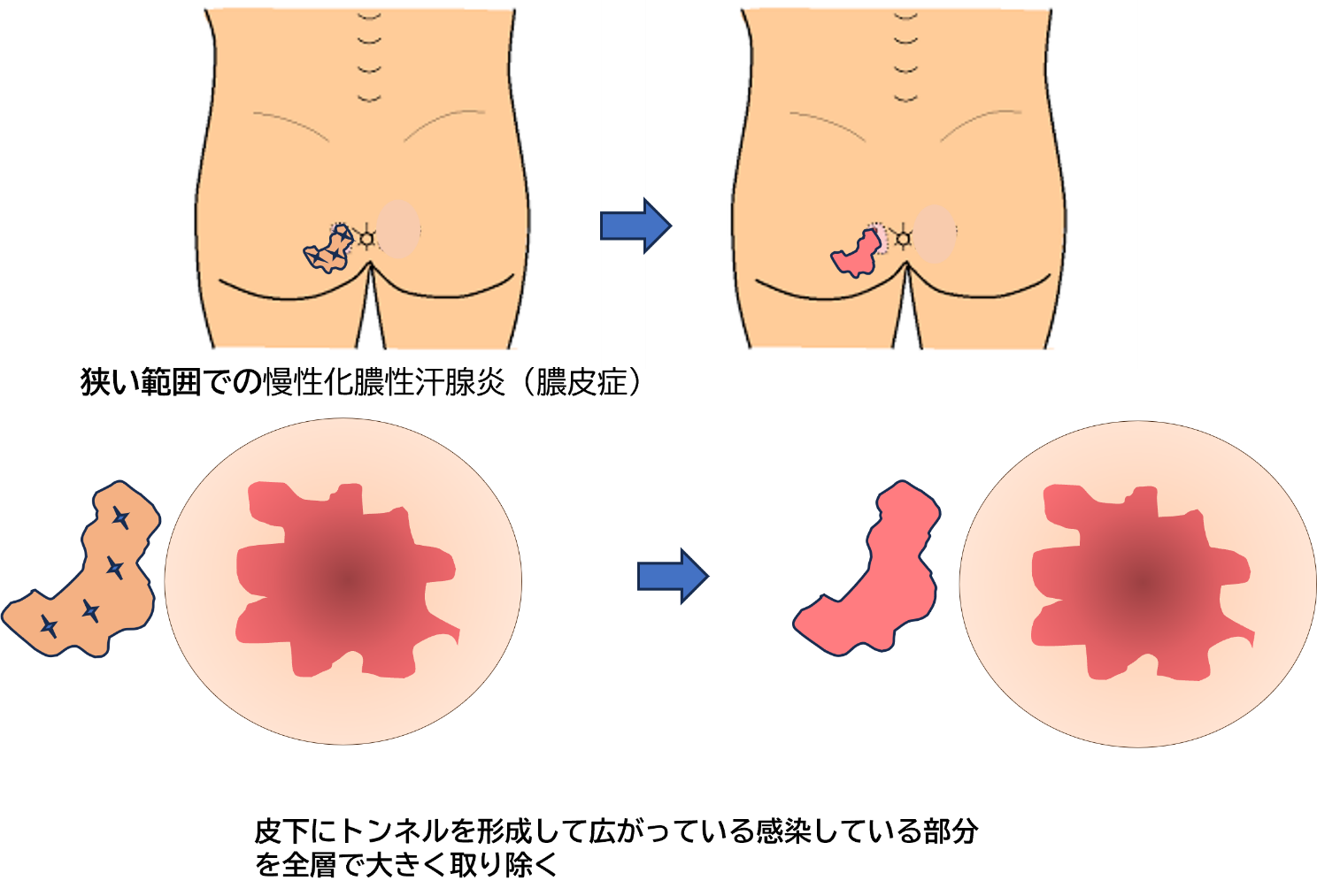 狭い範囲（軽度）の片側の慢性化膿性汗腺炎（膿皮症）手術