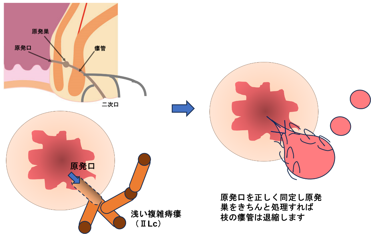 原発口１つであるが途中で枝分かれしている複雑化した痔瘻（ⅡLc、ⅡL