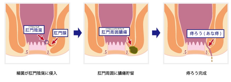 肛門陰窩より細菌混入した場合（この場合は結局、痔瘻となります）