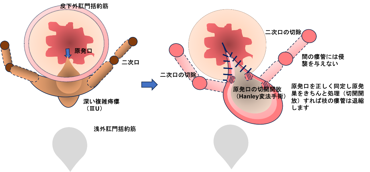 Hanley変法（原発口開放術式）