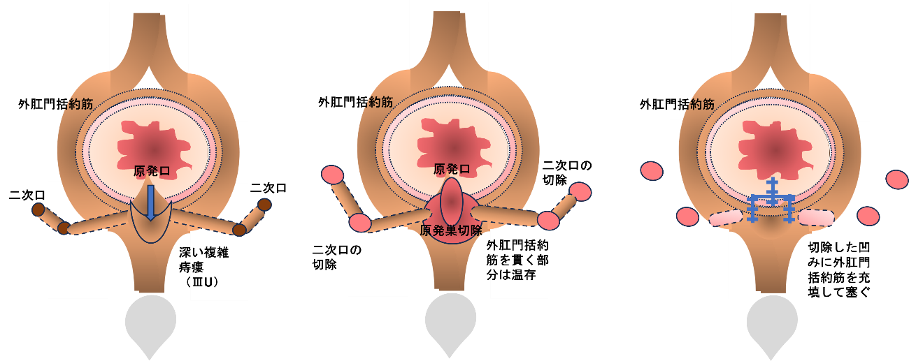 筋肉縫合術・筋肉充填術