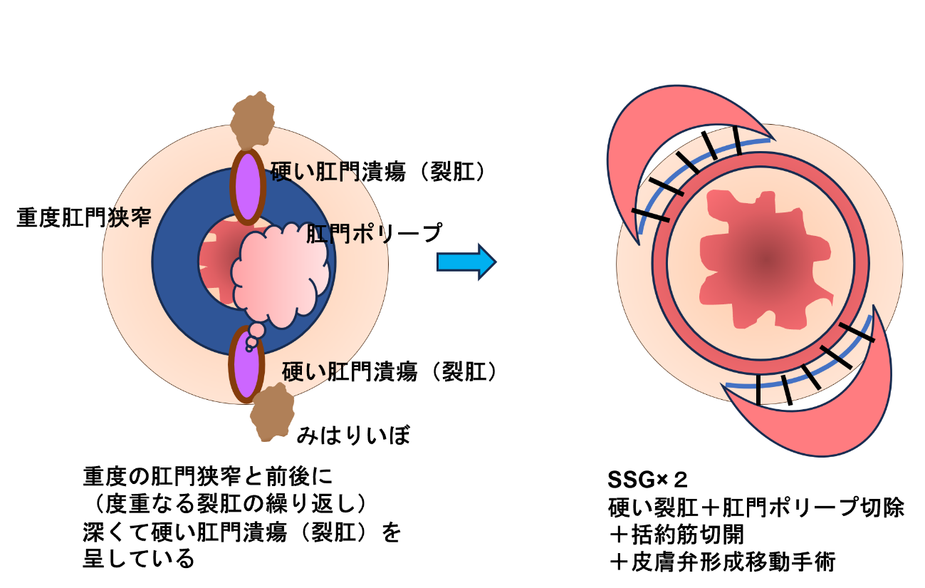 強度の肛門狭窄手術