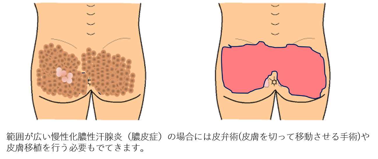 広範囲の膿皮症手術
