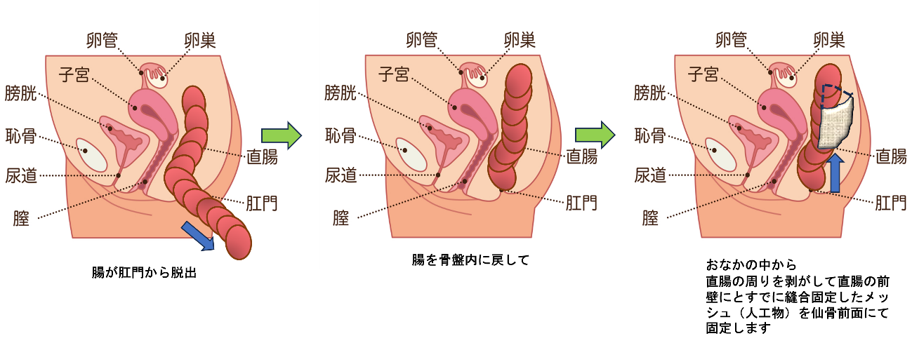 経腹的つり上げ手術方法