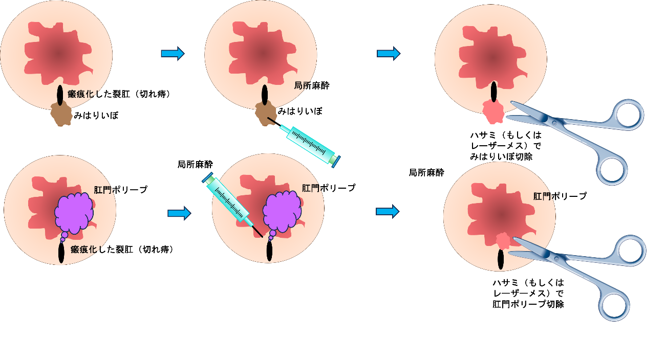 小さな　『みはりいぼ』　もしくは『肛門ポリープ』の切除