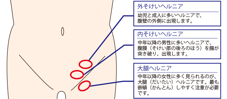 鼠径ヘルニアとは