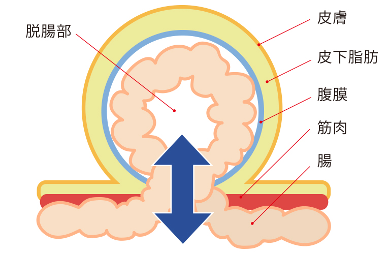 鼠径ヘルニアとは