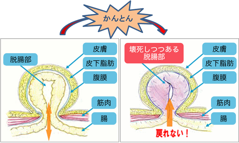 ソケイヘルニアの症状