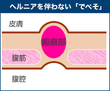 『でべそ』には簡単に以下の２つに分けられます。