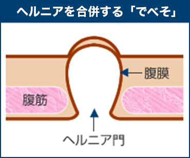 『でべそ』には簡単に以下の２つに分けられます。