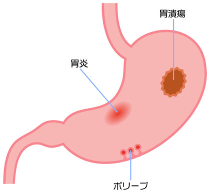 胃ポリープとは